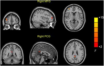 Altered dynamic intrinsic brain activity of the default mode network in Alzheimer’s disease: A resting-state fMRI study